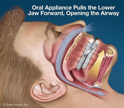 Oral Appliace Therapy